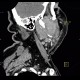 Lymphoma of parotid gland, lymphadenopathy: CT - Computed tomography